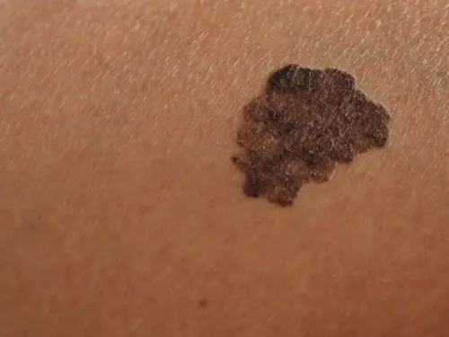 Mole removal